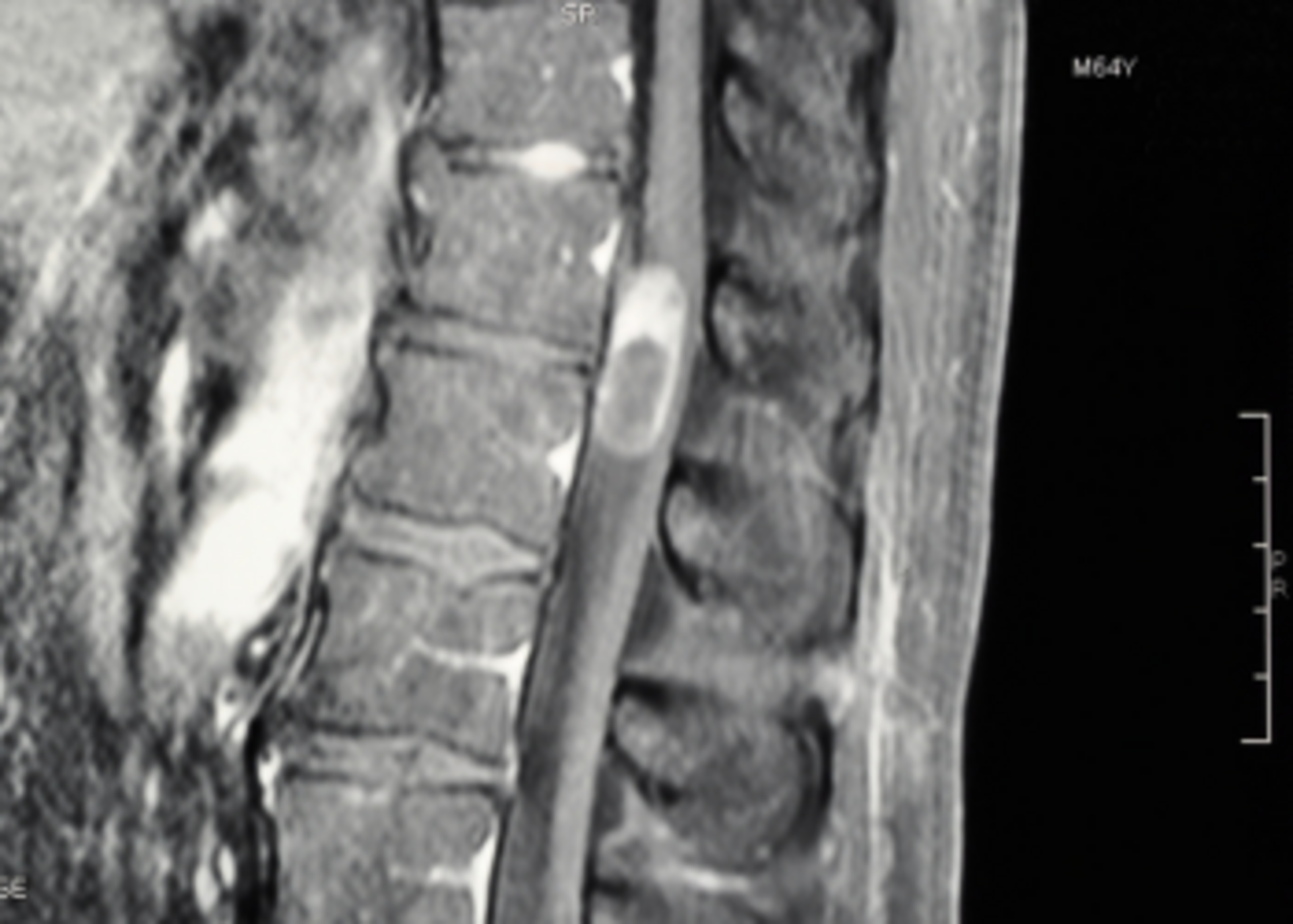 Spinal Tumor